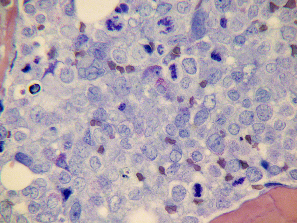 Some primitive cells contained clumps of metachromatic granules on giemsa stain.